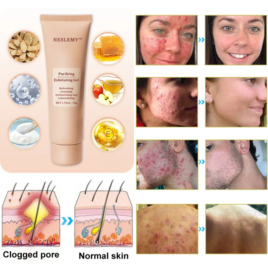 NESLEMY™ Purifying Exfoliating Gel for Acanthosis Nigricans, Exfoliation, Dark Spots, Skin Tags, and Eczema