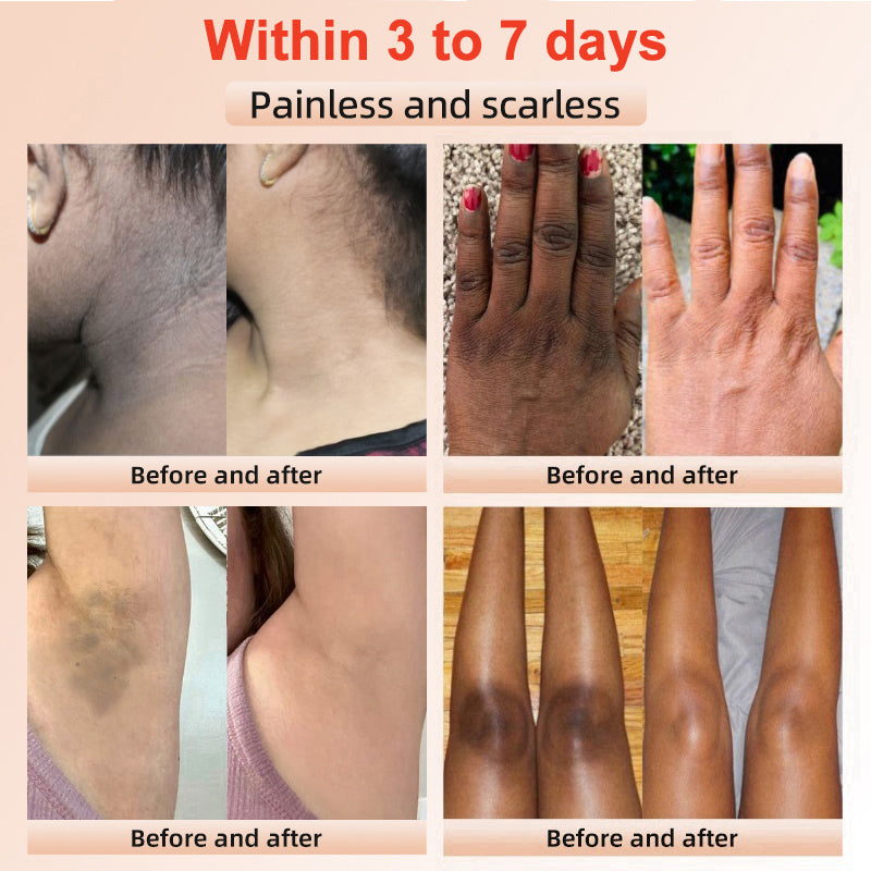 NESLEMY™ Purifying Exfoliating Gel for Acanthosis Nigricans, Exfoliation, Dark Spots, Skin Tags, and Eczema