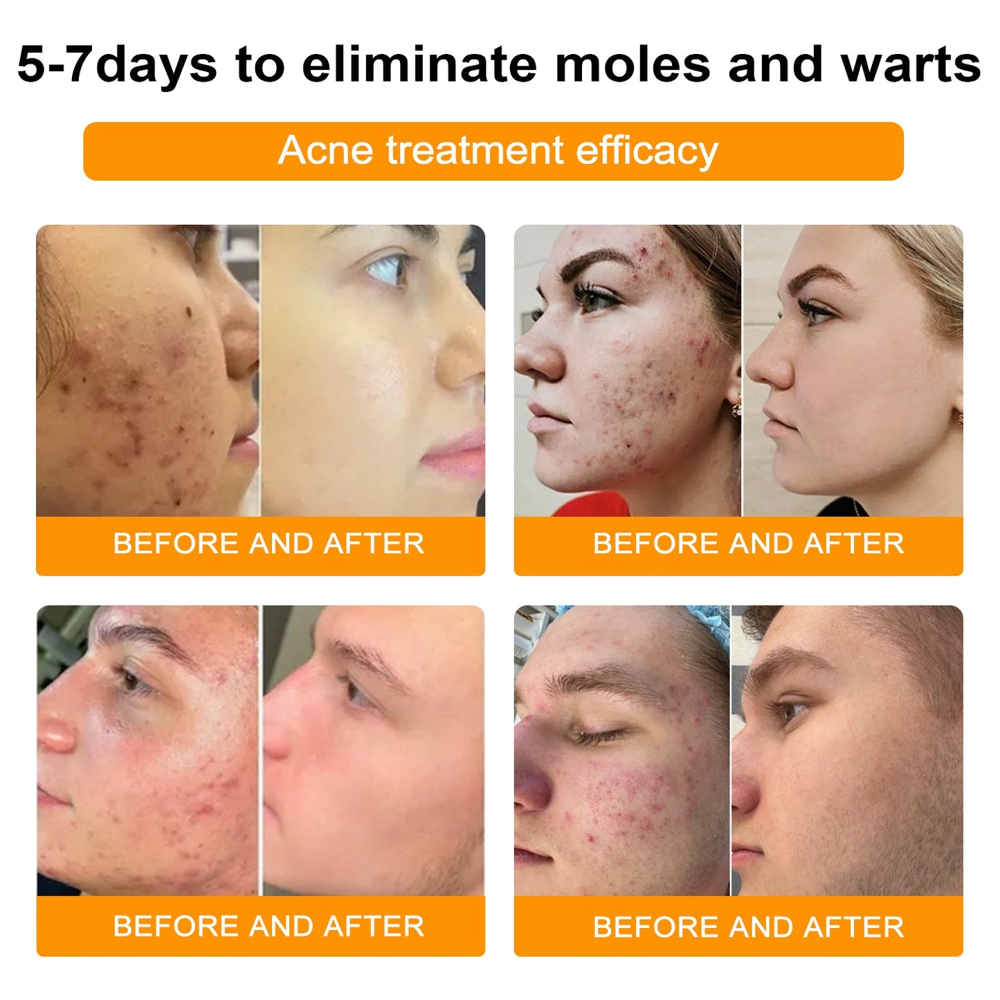 🐝🐝Bee Venom Mole and Wart Treatment Cream