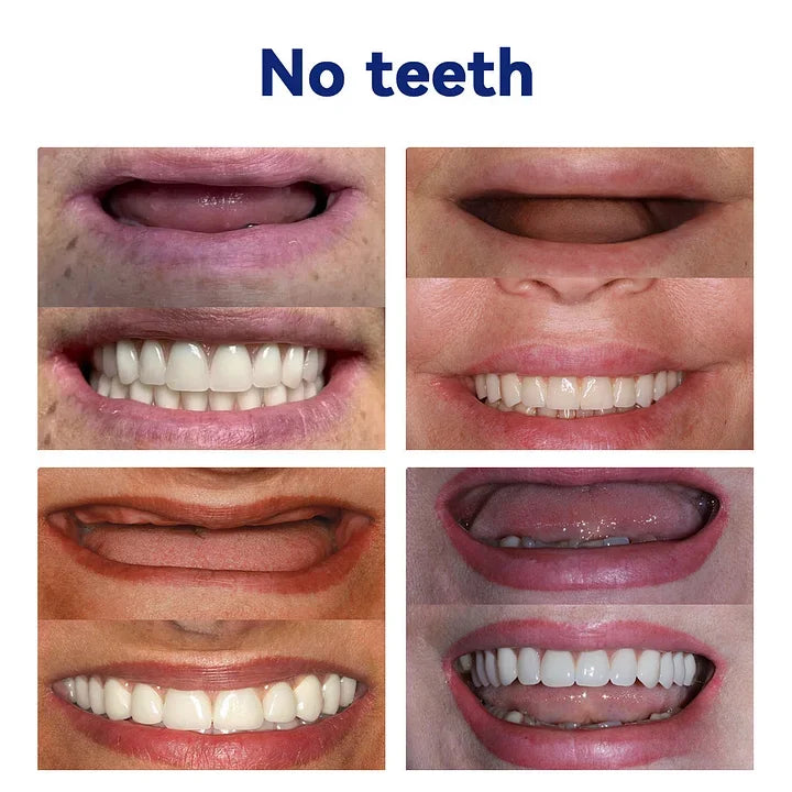 SmileFitPro™-New Generation Flexible Full Denture Solution