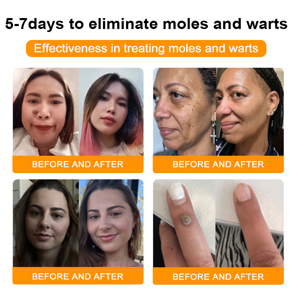 🐝🐝Bee Venom Mole and Wart Treatment Cream