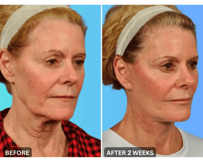 🔥Last Day 79% Off NESLEMY™ Skin Lift & Firm Beauty Device