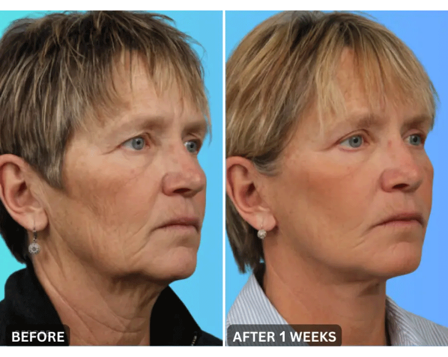 🔥Last Day 79% Off NESLEMY™ Skin Lift & Firm Beauty Device