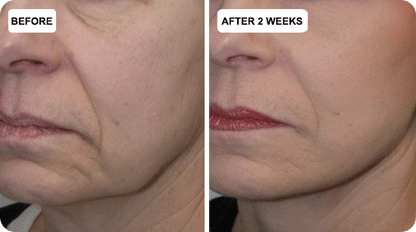 🔥Last Day 79% Off NESLEMY™ Skin Lift & Firm Beauty Device