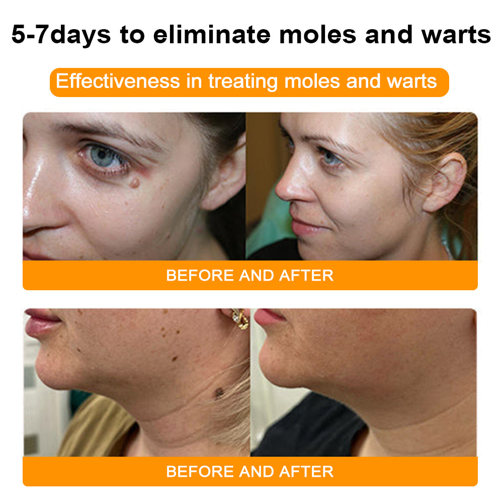 🐝🐝Bee Venom Mole and Wart Treatment Cream