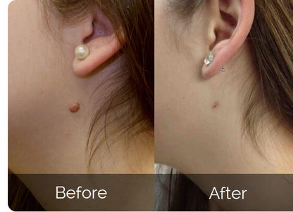 🔥[Official Brand Store] QIAWI™ Skin Tag Removal Kit - Pain-Free, Fast & Effective