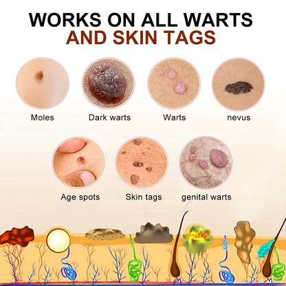 🐝🐝Bee Venom Mole and Wart Treatment Cream